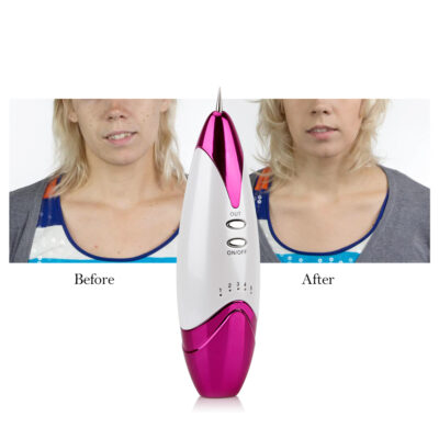 Laser Freckle Removal Machine | Skin Mole Dark Spot Face Wart Tag Remover Pen - Image 4