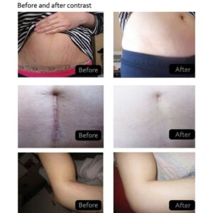 Stretch Marks skin Repair Cream-3