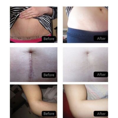 Stretch Marks skin Repair Cream | natural stretch mark cream - Image 6