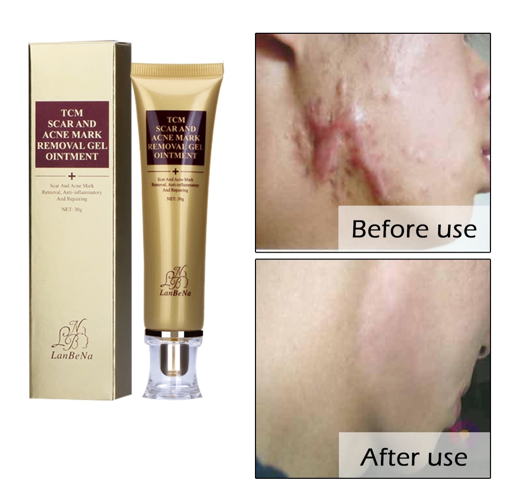 acne scar removal cream