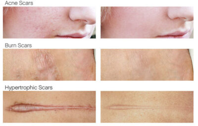silicone scar sheets  | scar therapy | 2 sizes - Image 2