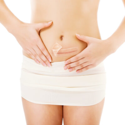 silicone scar sheets  | scar therapy | 2 sizes