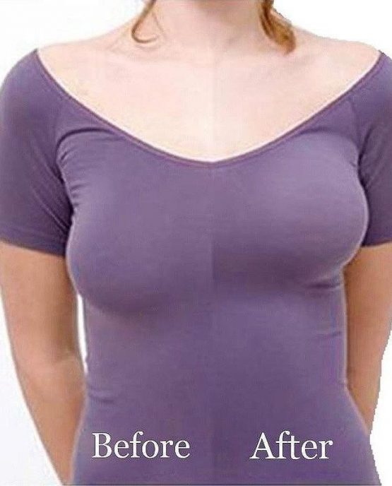 breast lift adhesives