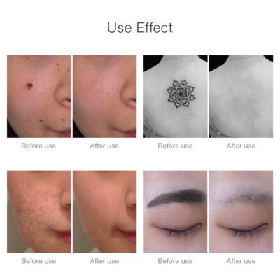 NEATCELL Laser (Spider Veins Acne Mole Warts Freckles) Tattoo Remover - Image 5