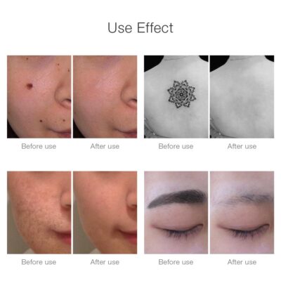 ORIGINAL! NEATCELL Removes Spider Veins, Tattoos, Acne, Mole - Image 6