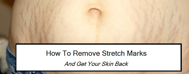 How to remove stretch marks – And Get Your Skin Back