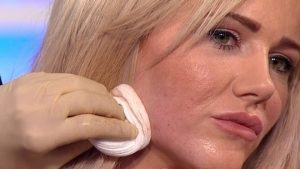 adult acne
